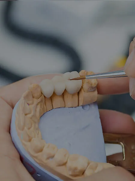 A dental model of a denture being worked on